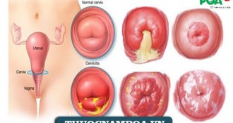 Triệu chứng viêm lộ tuyến cổ tử cung chuẩn xác: Chị em thường dễ bỏ qua